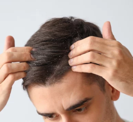 dandruff treatment singapore