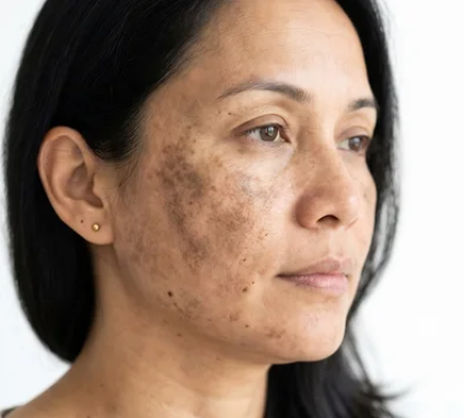 melasma treatment singapore